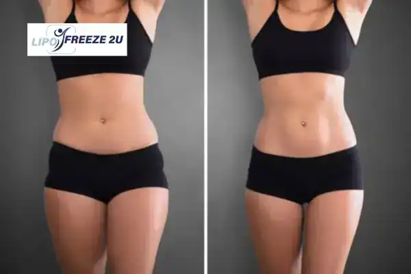 How Can LIPO FREEZE 2U Support Your Post-Pregnancy Body Recovery Swadlincote?