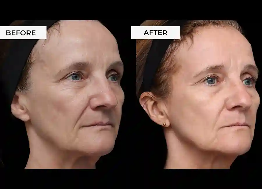 How Many RF Microneedling Sessions Will You Need to See a Difference Swadlincote?