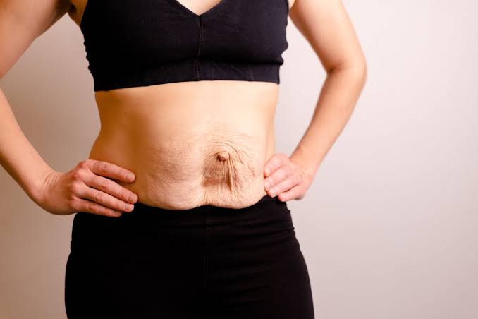 Is Surgery Really the Only Way to Repair Diastasis Recti Swadlincote?
