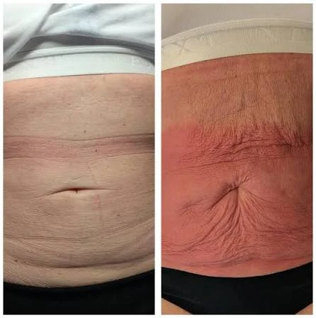 How Does RF Microneedling Improve Crepey, Thin and Uneven Skin Texture Swadlincote?
