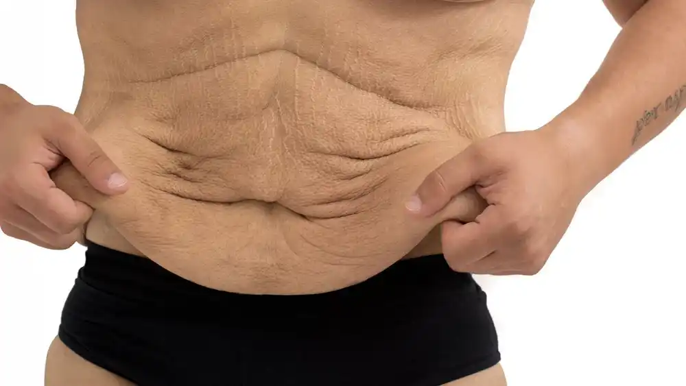 Why Does Weight Loss Medication Leave Some People With Loose or Sagging Skin Swadlincote?